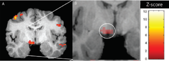 Signals of brain activation in early premonitory phase of migraine