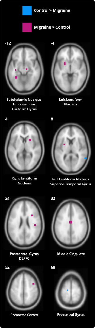 Noxious heat induced activations differing between migraine and control subjects, from Schwedt et al.3