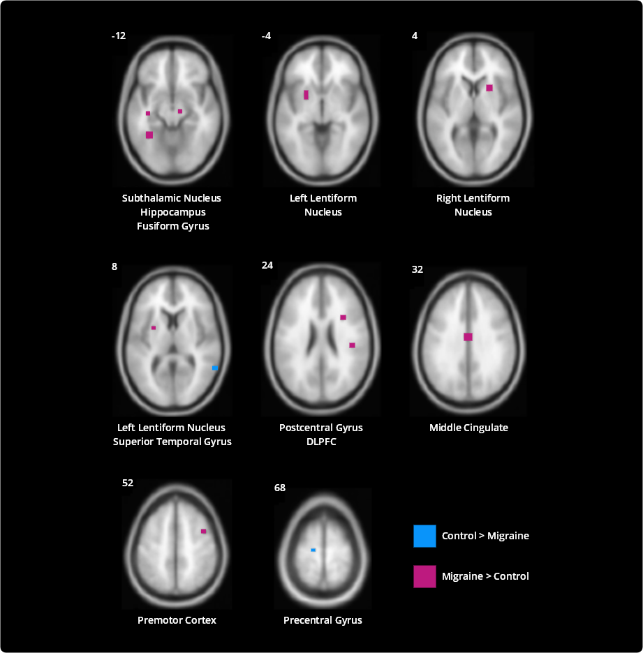 Noxious heat induced activations differing between migraine and control subjects, from Schwedt et al.3