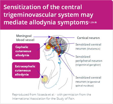Contribution of trigeminovascular system sensitization to allodynia symptoms in migraine